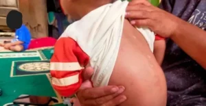 Kondisi anak yang terdampak perusakan lingkungan di Desa Kawasi, Pulau Obi, Halmahera Selatan akibat aktivitas pertambangan nikel Harita. (Foto: dok. Konde.co/Anita Dhewy)